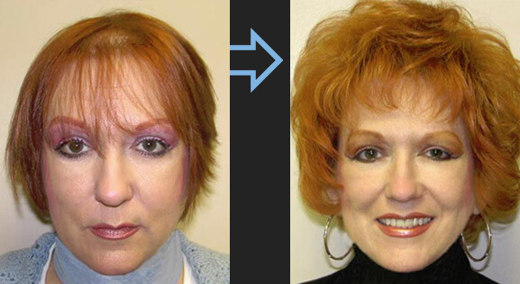 Résultat de greffe de cheveux femmes