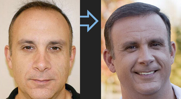 Résultat de greffe de cheveux homme