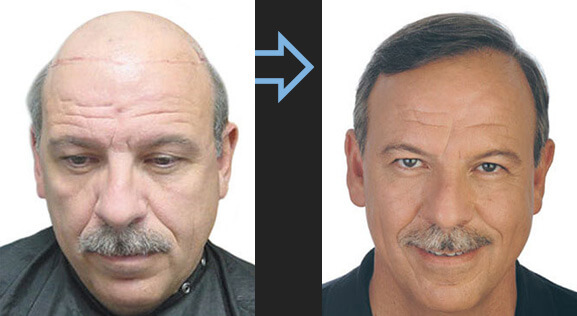 Photo avant/après d'une restauration capillaire