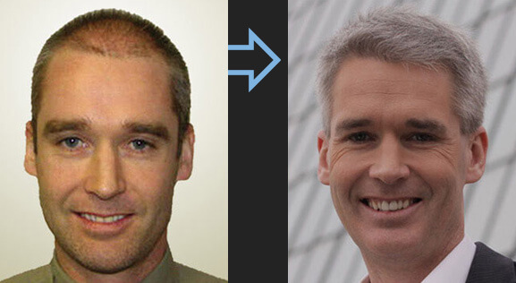 Photo greffe capillaire homme